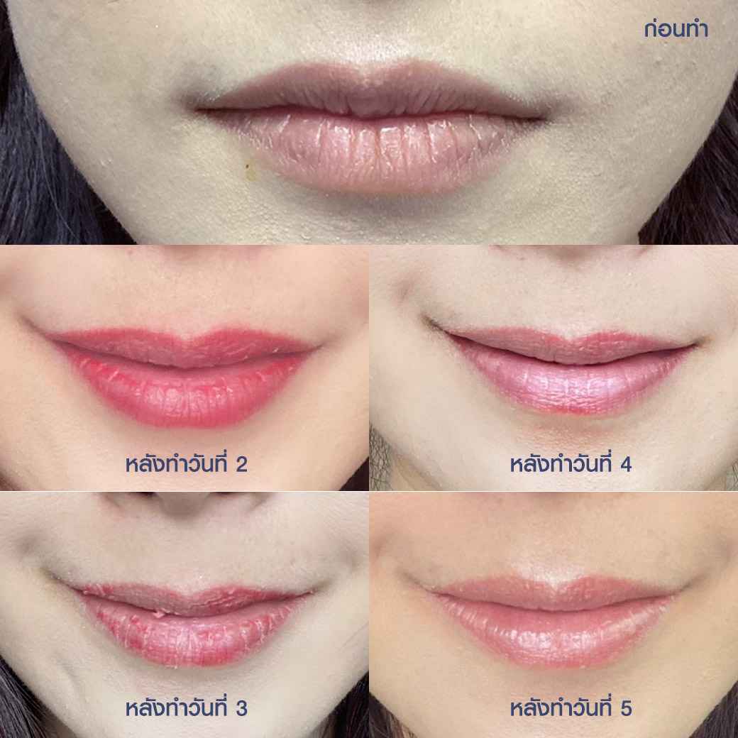 รีวิวฝังสีปาก Claire,รีวิวสักปาก,สักปาก,ฝังสีปาก,ฝังสีปาก Russian Volume Lips