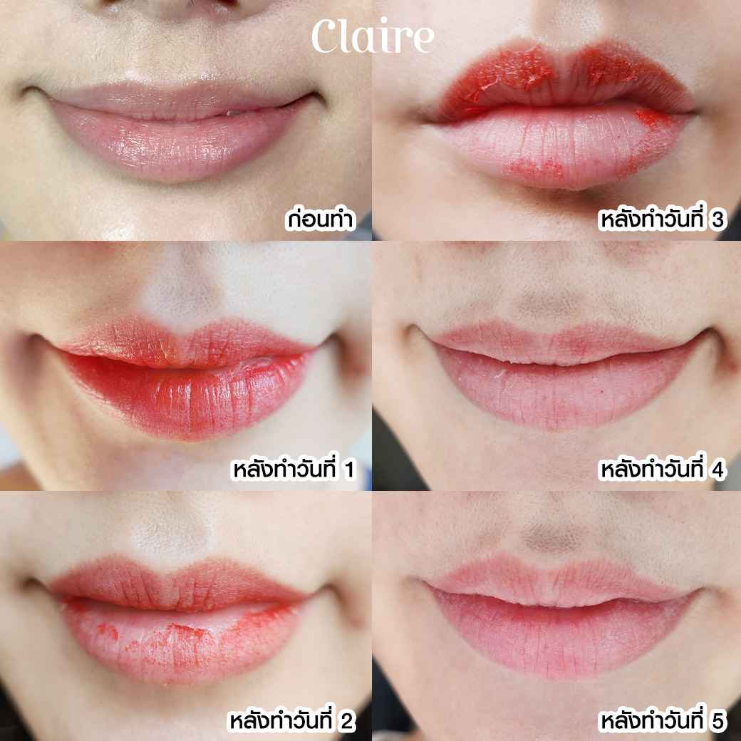 รีวิวฝังสีปาก Claire,รีวิวสักปาก,สักปาก,ฝังสีปาก,ฝังสีปาก Russian Volume Lips